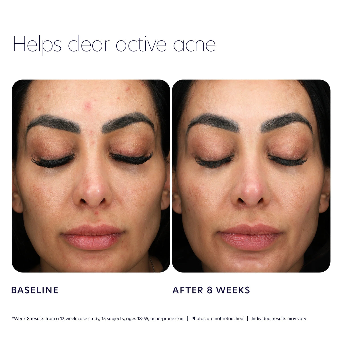 Acne Control Prebiotic Gel Cleanser 7 oz