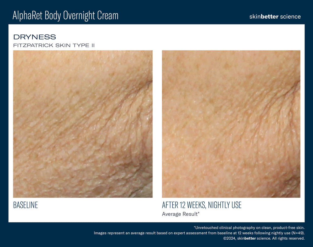 AlphaRet Body Overnight Cream