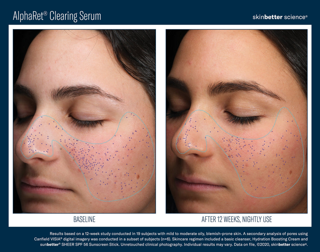 AlphaRet Clearing Serum 30 ml