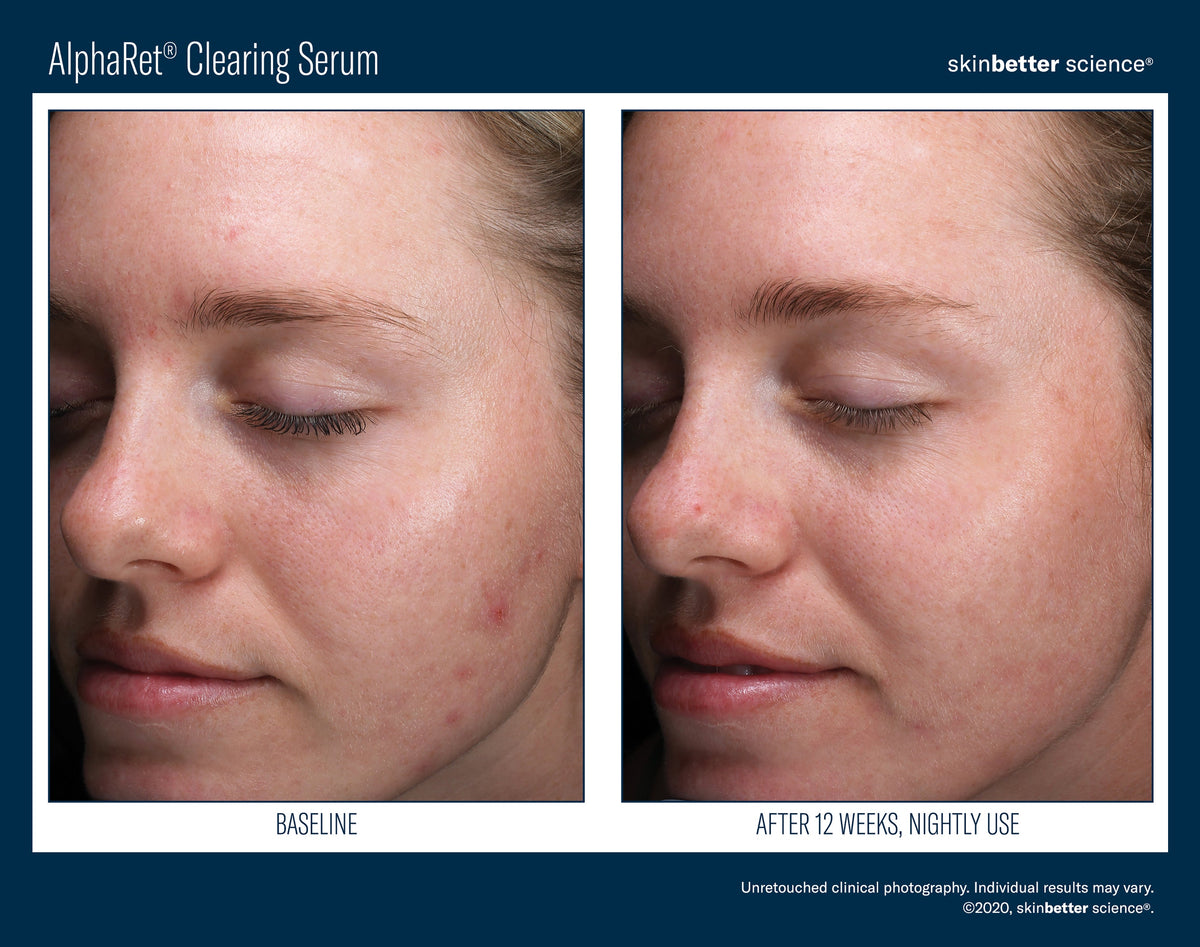 AlphaRet Clearing Serum 50 ml