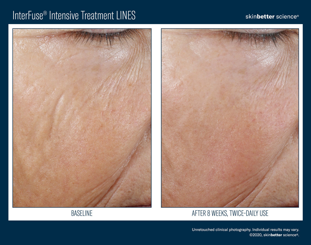 InterFuse Intensive Treatment LINES 30 ml