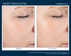 AlphaRet Exfoliating Peel Pads
