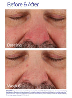 Rozatrol for Red Sensitized Skin